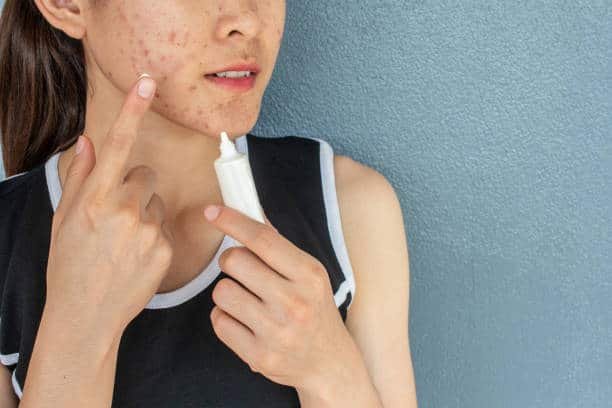 علاج حب الشباب