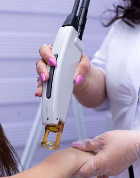 ازالة الشعر بالليزر