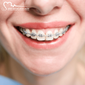 علاج تقويم الأسنان