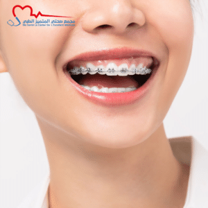 علاج تقويم الأسنان