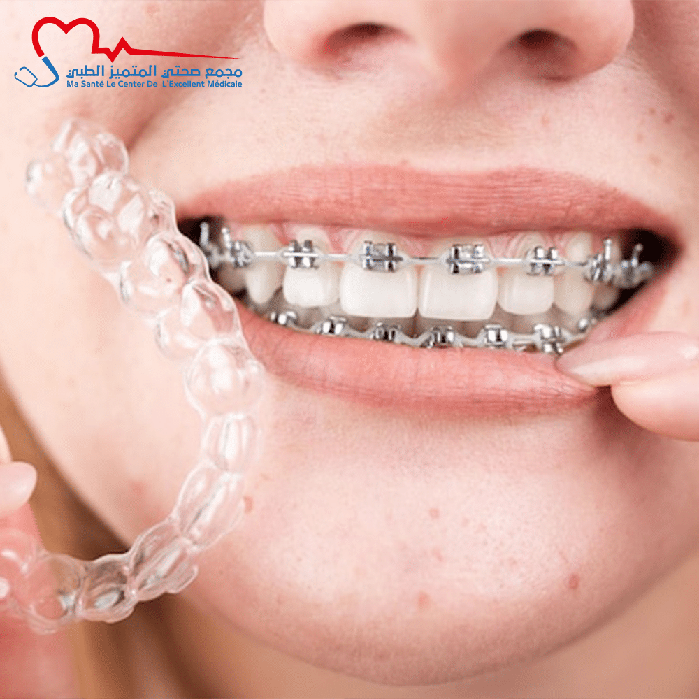 تقويم الأسنان المعدني